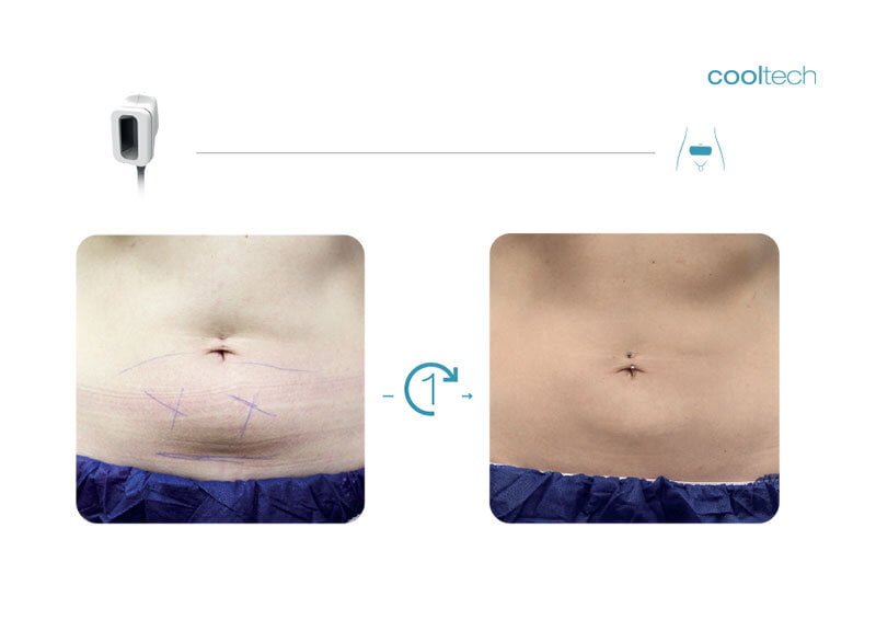 What is Cooltech Technology - Cryoadipolysis - Cooltech Fat Freezing Results - Slide 3