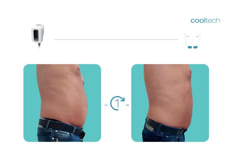 What is Cooltech Technology - Cryoadipolysis - Cooltech Fat Freezing Results - Slide 4