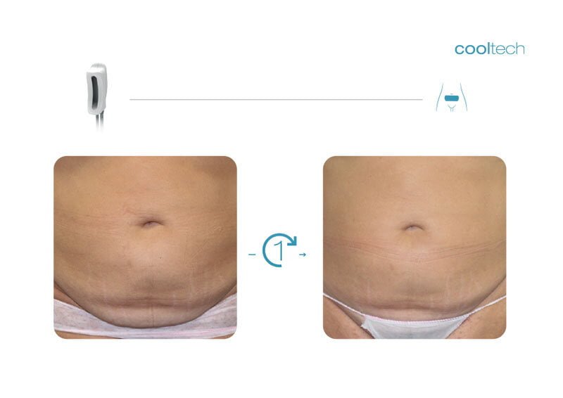 What is Cooltech Technology - Cryoadipolysis - Cooltech Fat Freezing Results - Slide 5