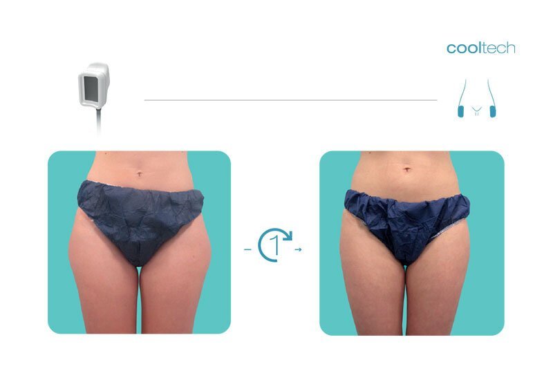 What is Cooltech Technology - Cryoadipolysis - Cooltech Fat Freezing Results - Slide 6