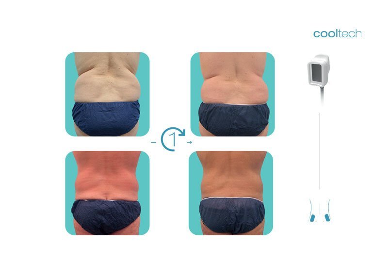 What is Cooltech Technology - Cryoadipolysis - Cooltech Fat Freezing Results - Slide 8