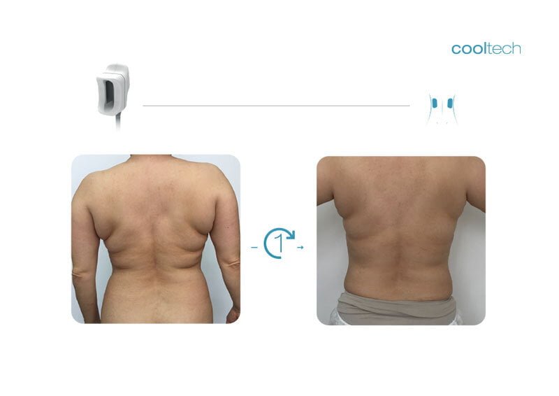 What is Cooltech Technology - Cryoadipolysis - Cooltech Fat Freezing Results - Slide 8