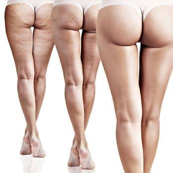 how-to-reduce-cellulite-cellulite-reduction-reduce-cellulite-cellulite-treatments-cellulite-before-and-after-how-much-is-cellulite-reduction-on-buttocks