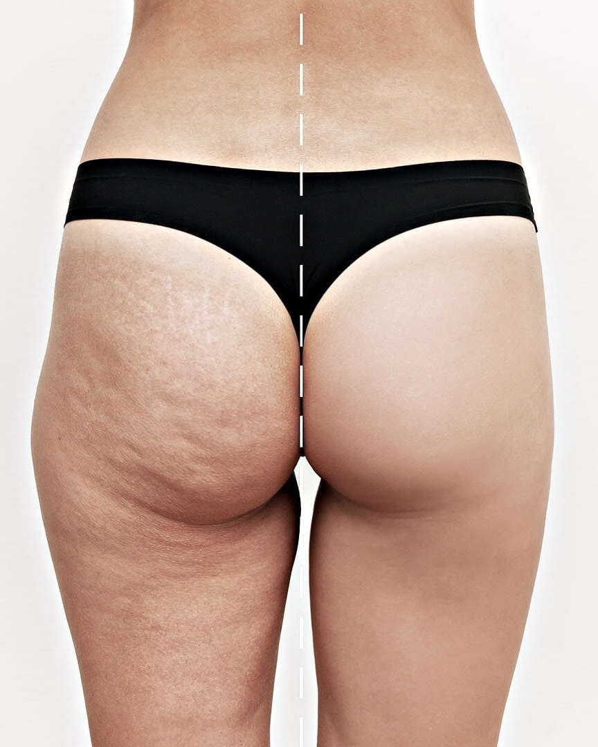 how-to-reduce-cellulite-cellulite-reduction-reduce-cellulite-cellulite-treatments-cellulite-before-and-after-how-much-is-cellulite-reduction